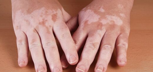 масло тмина витилиго